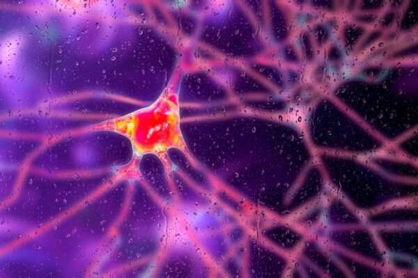 Preliminary but promising gene therapy shows a 75% reduction in the progression of Huntington’s disease Photo: Dementia neurons, conceptual illustration
